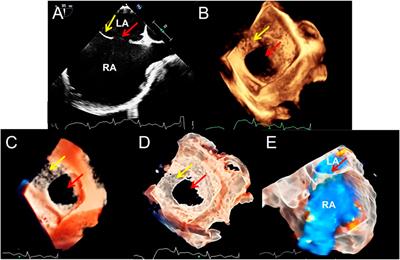 Novel TrueVue series of 3D echocardiography: Revealing the pathological morphology of congenital heart disease